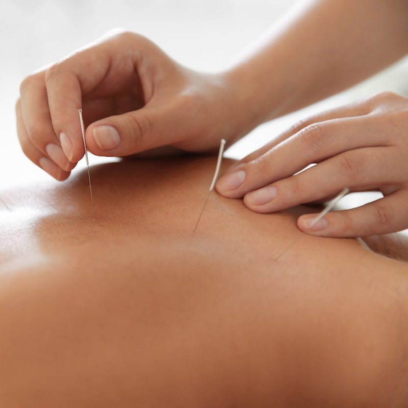 Rug nek schouder massage ( in combi. met Dry Needling)
