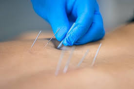 Dry Needling Therapie